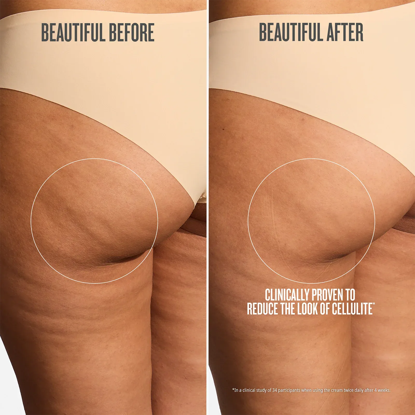 Before and after comparison of cellulite reduction on a person's thigh.