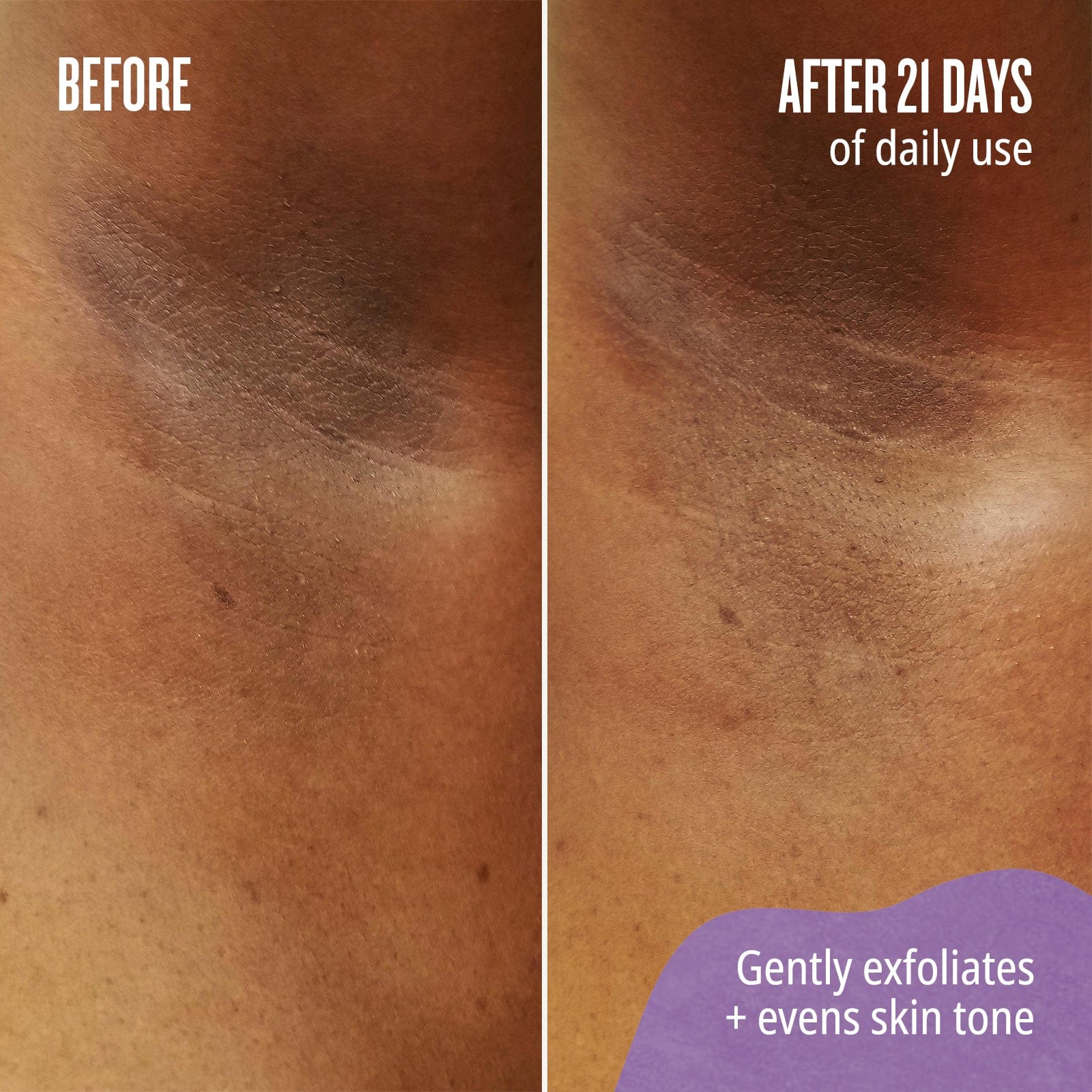 before // after 21 days of daily use - gently exfoliates + evens skin tone