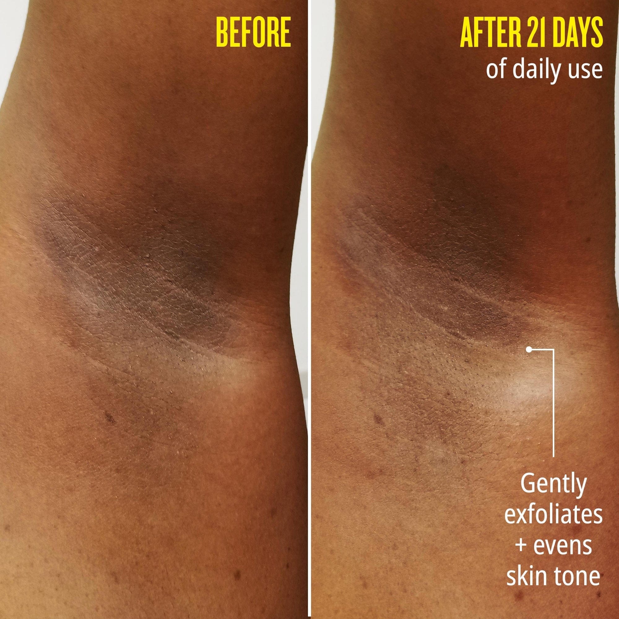 Before // After 21 days of daily use. Gently exfoliates + evens skin tone