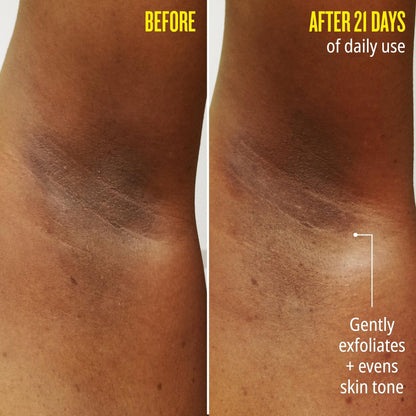 Before // After 21 days of daily use. Gently exfoliates + evens skin tone