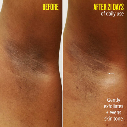 before | after 21 days of daily use gently exfoliates and evens skin tone