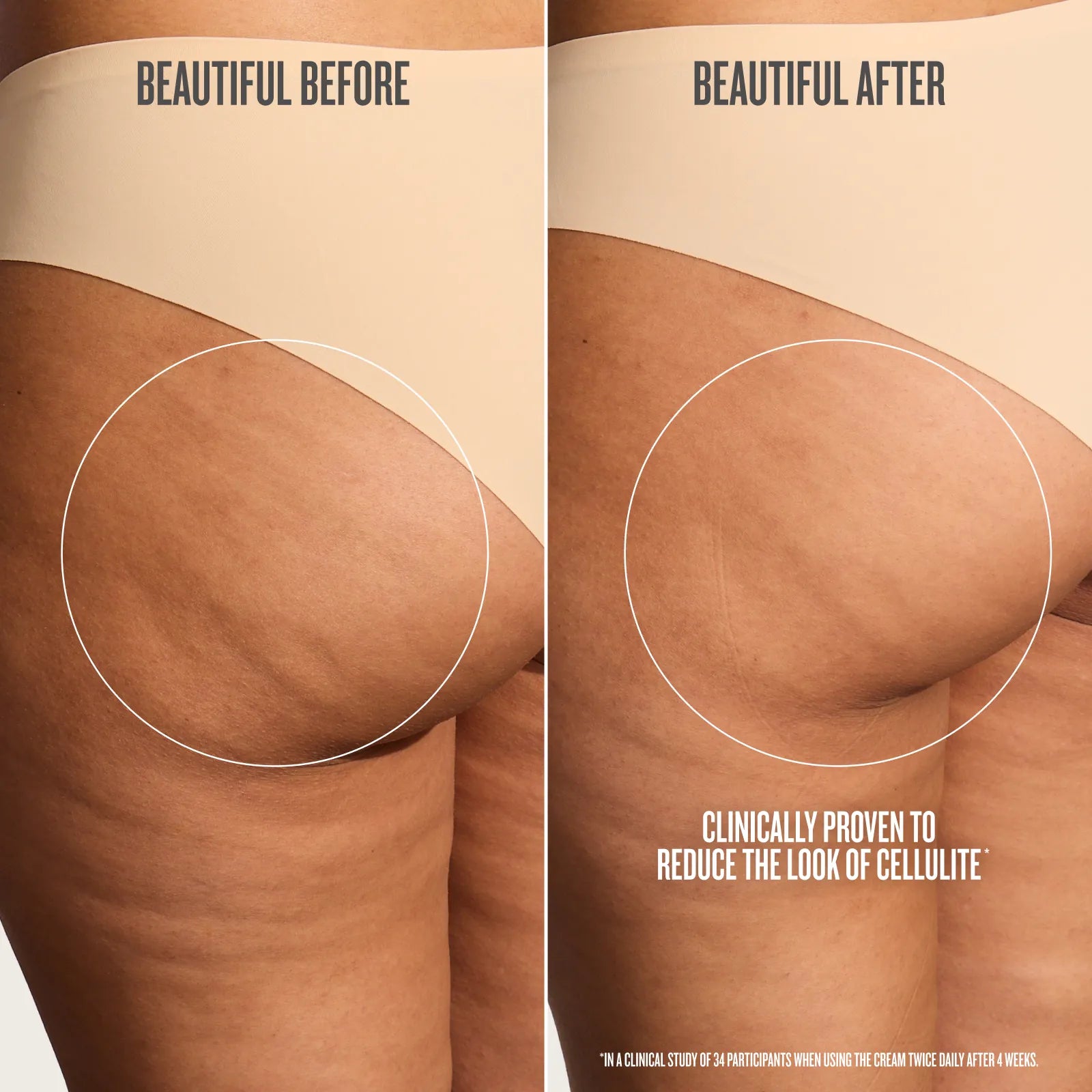Before-and-after comparison showing the lower torso and hip area of a person wearing beige underwear, with text reading 'BEAUTIFUL BEFORE' and 'BEAUTIFUL AFTER' and a note about reducing the look of cellulite.