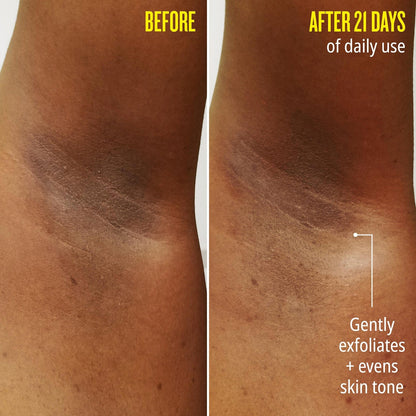 Before | After 21 Days of daily use - gently exfoliates + evens skin tone